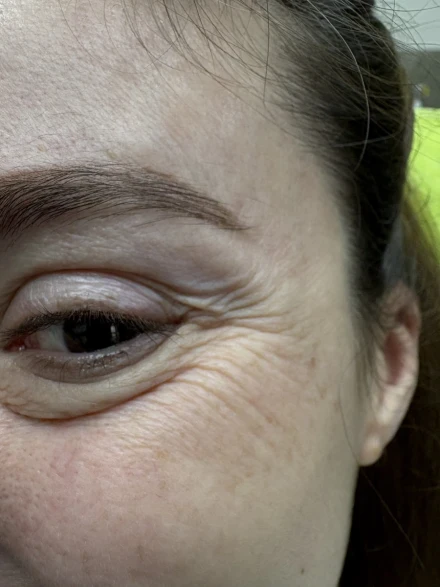 поставяне на ботокс