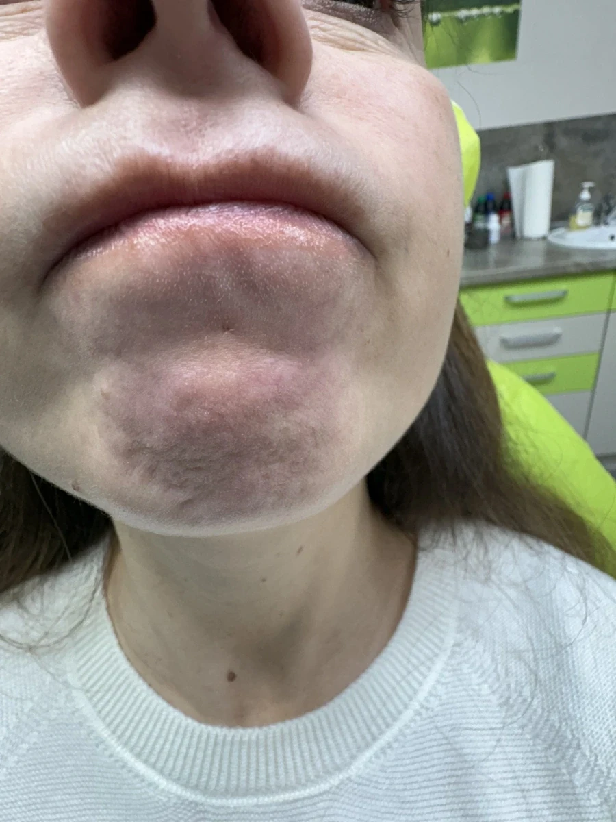 поставяне на ботокс - Reservation.Studio поставяне на ботокс - Reservation.Studio