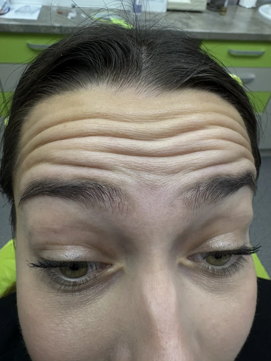 поставяне на ботокс - Reservation.Studio