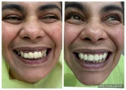 циментиране на корона/мост циментиране на корона/мост