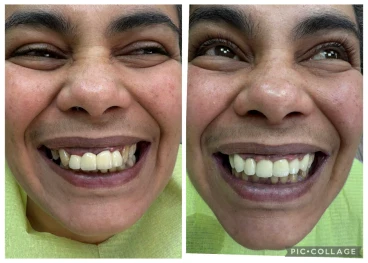 циментиране на корона/мост циментиране на корона/мост