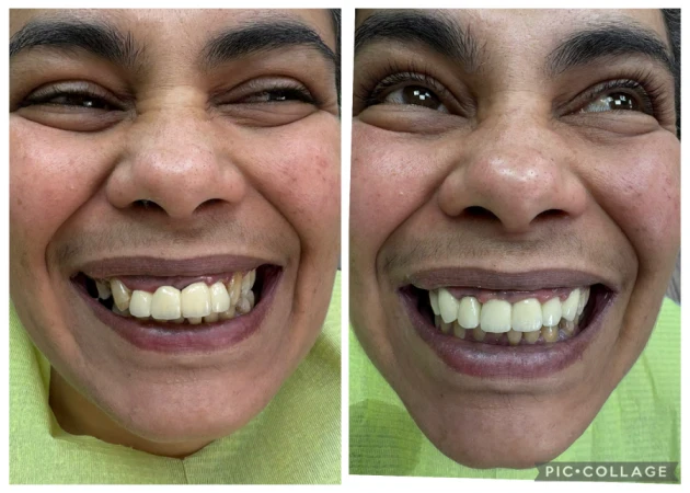 циментиране на корона/мост - Reservation.Studio