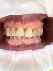 отпечатък за мост отпечатък за мост