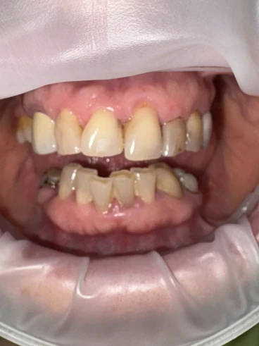 отпечатък за мост отпечатък за мост