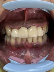 отпечатък за мост отпечатък за мост