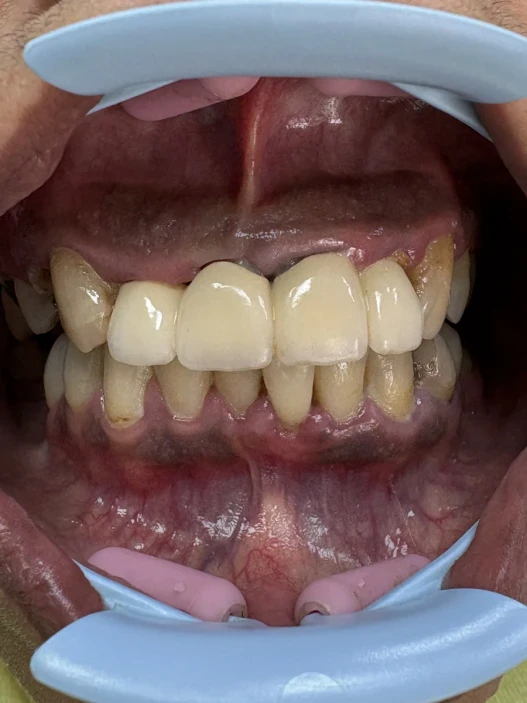 отпечатък за мост отпечатък за мост