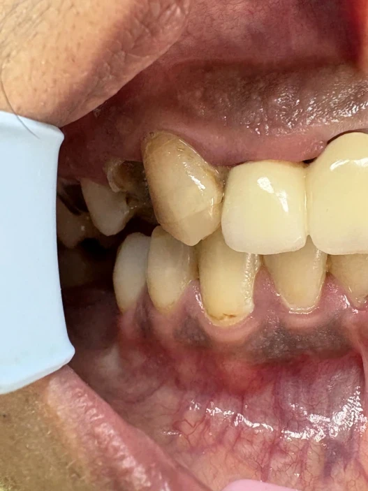 отпечатък за мост отпечатък за мост