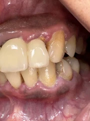 отпечатък за мост отпечатък за мост