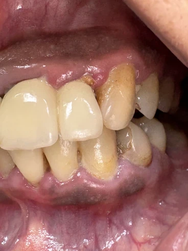 отпечатък за мост отпечатък за мост