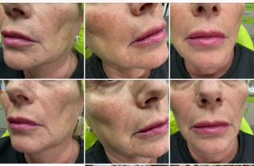 поставяне на филър