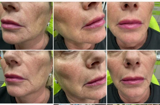 поставяне на филър поставяне на филър