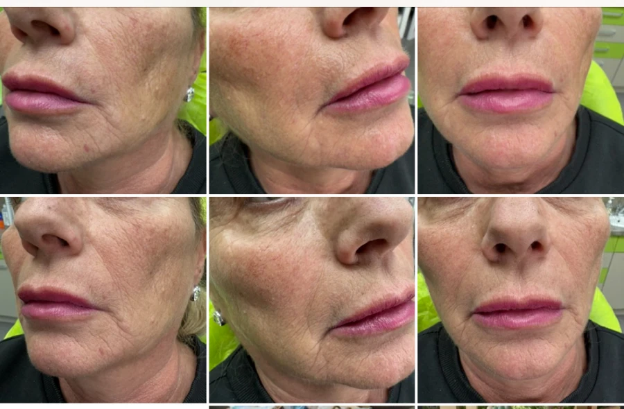 поставяне на филър - Reservation.Studio поставяне на филър - Reservation.Studio