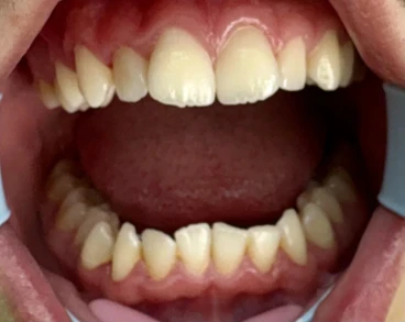 отпечатък за алайнери отпечатък за алайнери