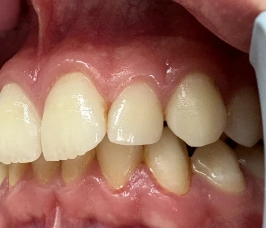 отпечатък за алайнери