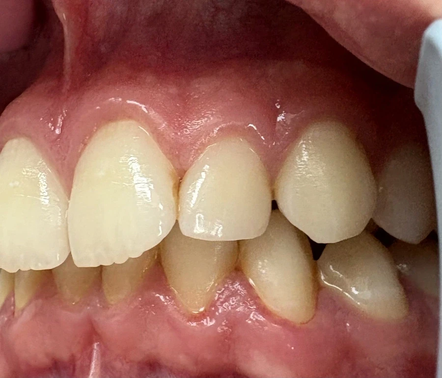 отпечатък за алайнери - Reservation.Studio