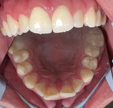 отпечатък за алайнери