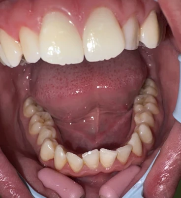 отпечатък за алайнери отпечатък за алайнери