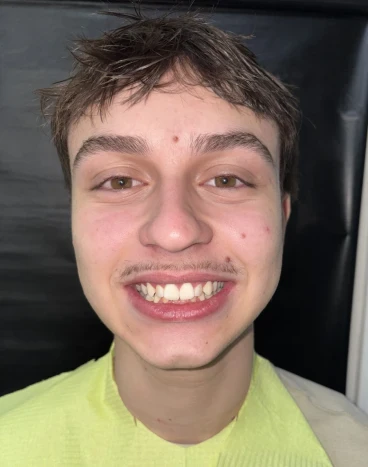 отпечатък за алайнери отпечатък за алайнери