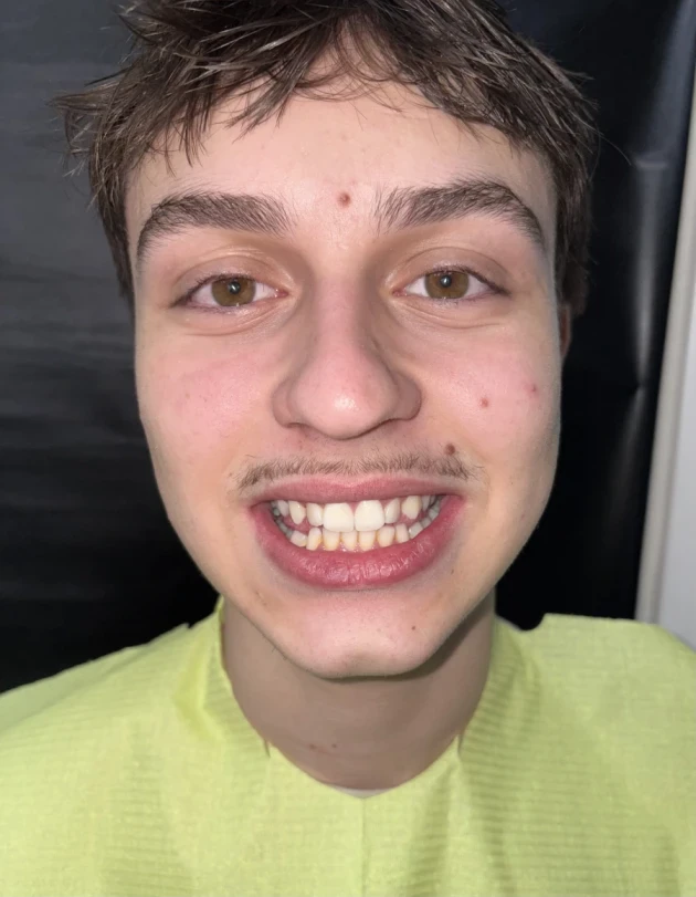 отпечатък за алайнери - Reservation.Studio