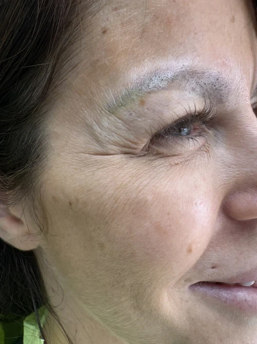 лечение на кариес,обтурация лечение на кариес,обтурация