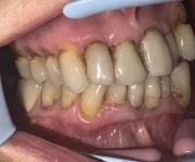 отпечатък за мост