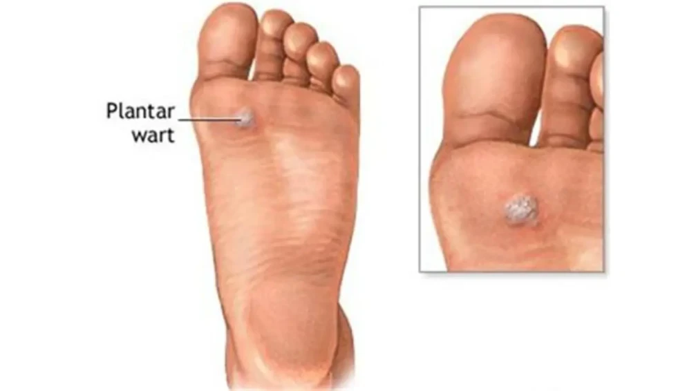 🦠 Entfernung einer Fußsohlenwarze