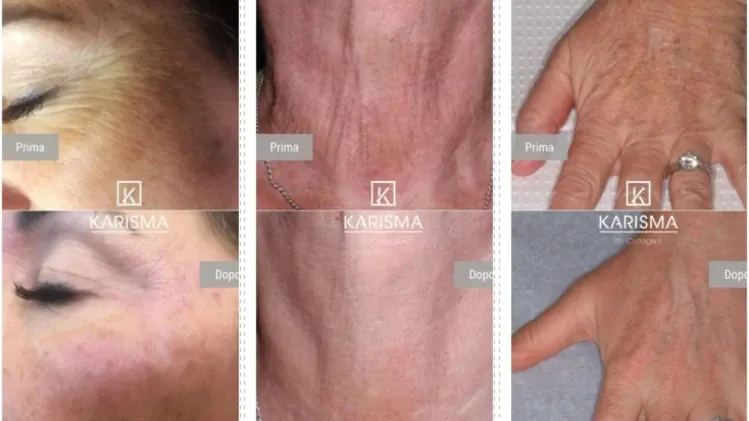 🧬 Биоревитализираща терапия Karisma 2.0ml 🧬 Биоревитализираща терапия Karisma 2.0ml