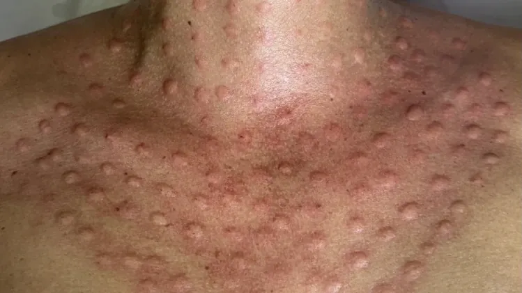 💉 Мезотерапия на шия и деколте Jalutox (Jalupro Classic + Botox) 💉 Мезотерапия на шия и деколте Jalutox (Jalupro Classic + Botox)