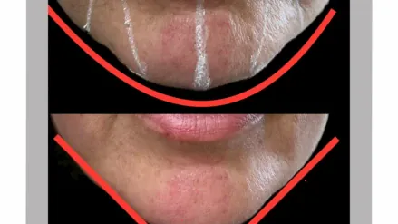 💉 Оформяне на брадичка с хиалуронов филър 💉 Оформяне на брадичка с хиалуронов филър