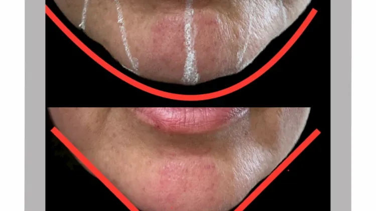 💉 Оформяне на брадичка с хиалуронов филър