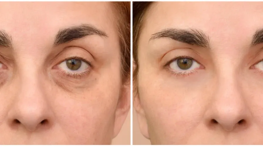 👁️ Filler ialuronico per gli occhi (solco lacrimale)