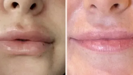 💉 Разграждане на филър 💉 Разграждане на филър