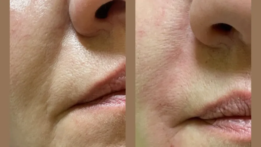 💉 Запълване на назолабиални бръчки с хиалуронов филър