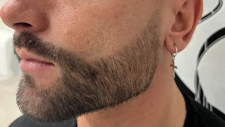 💉 Оформяне на долна челюст (Jawline) с хиалуронов филър