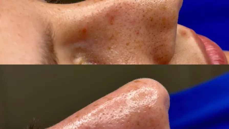 Дълбоко комбинирано апаратно почистване на лице с грижа от Juliette Armand