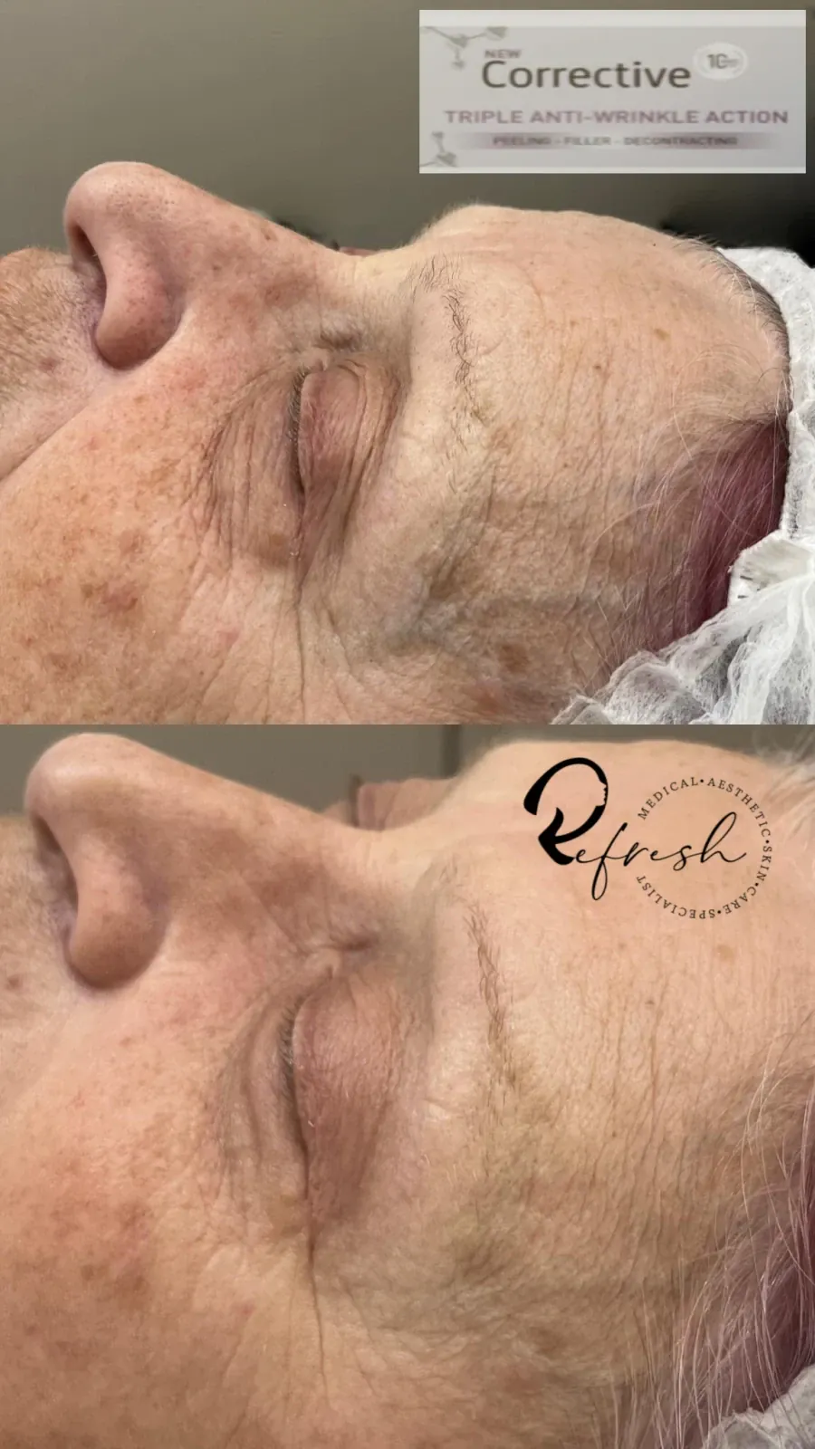 Corrective SKEYNDOR - "Ботокс лайк" за мимически и дълбоки бръчки - Reservation.Studio Corrective SKEYNDOR - "Ботокс лайк" за мимически и дълбоки бръчки - Reservation.Studio